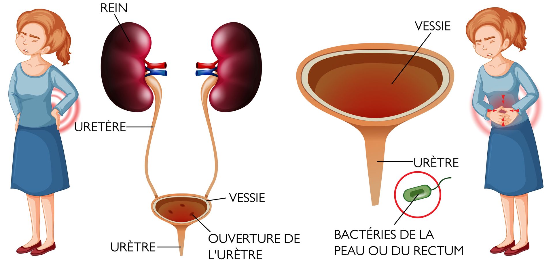 Cystite : Infection du systme urinaire
